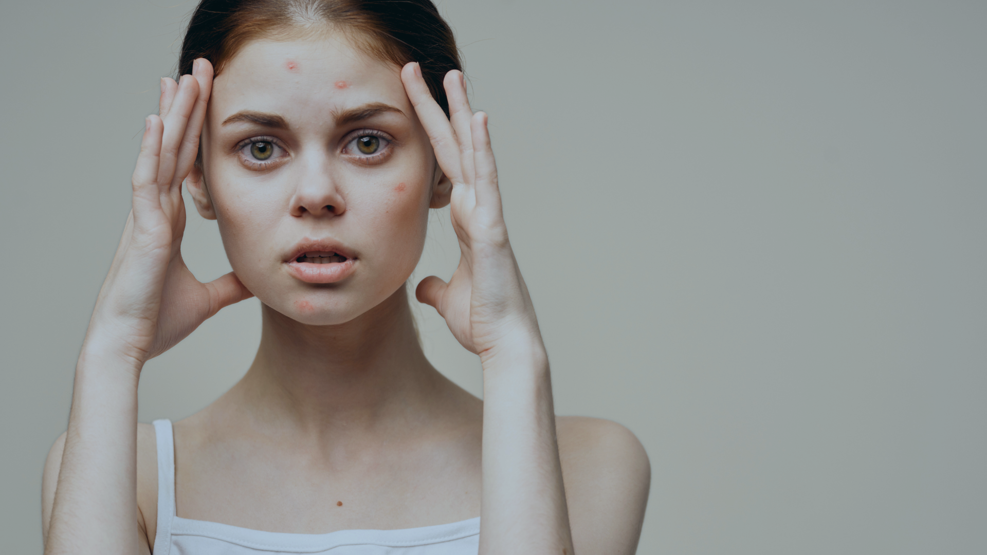 Expert Acne Management Consultation